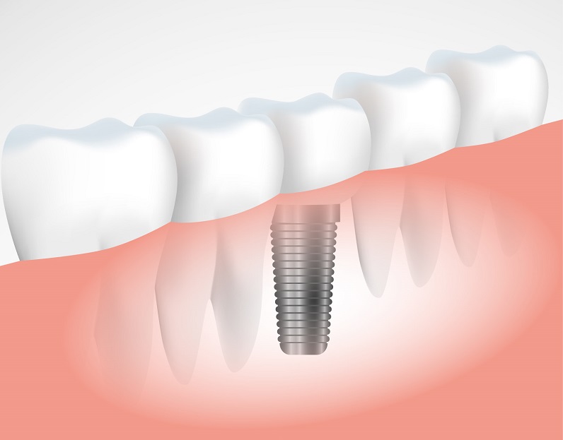 Dental Implants FairFax