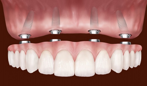 Dental Implants FairFax, VA
