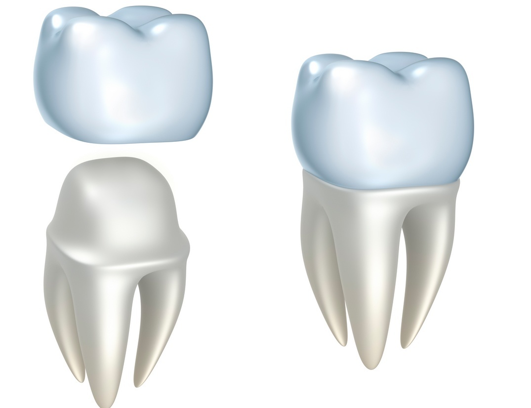 Dental Crowns FairFax