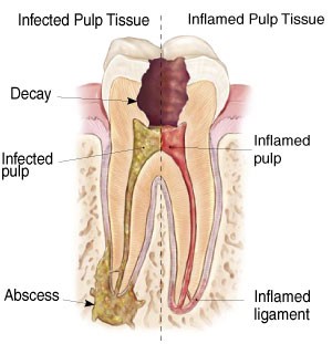 Root Canal Therapy FairFax