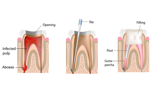 root canal therapy FairFax, VA
