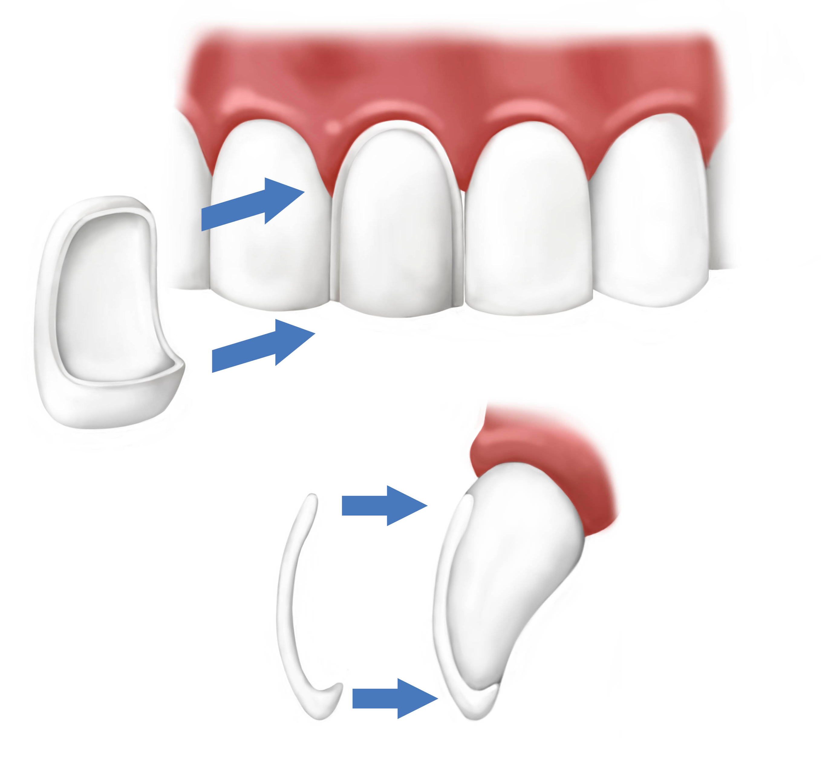 Dental veneers FairFax, VA