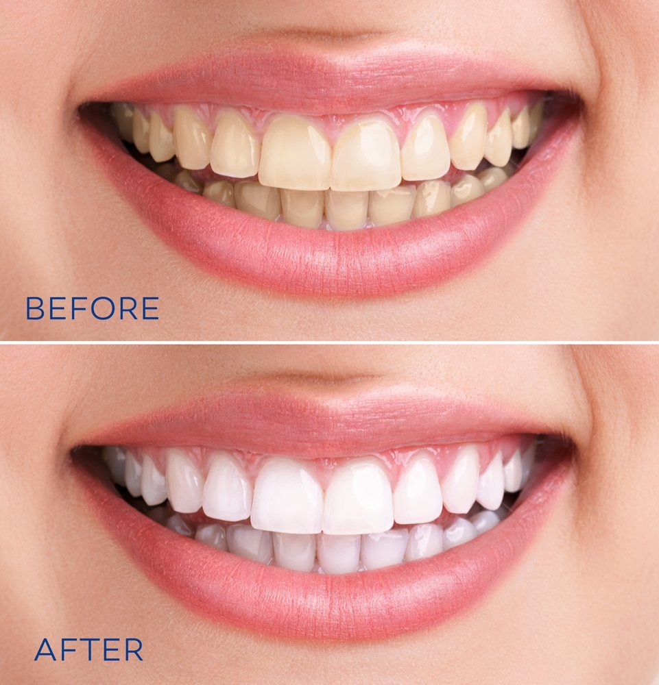 Dental whitening FairFax